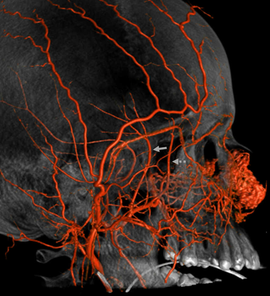 Deep Temporal Arteries Neuroangio Org